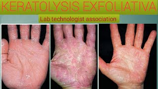 Everything you know about keratolysis exfoliativa [upl. by Elehcin992]