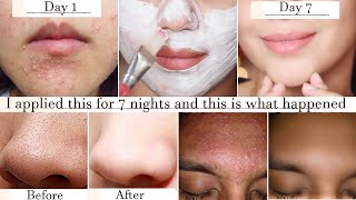 In 7 days get rid of tiny bumps pimples whiteheads and clogged pores amp get clear bright complexion [upl. by Llenrac707]