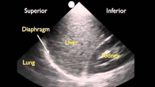 How To Ultrasound Detection of Pleural Fluid Case Study Video [upl. by Renny]