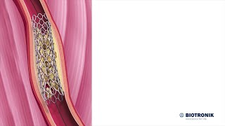 Angioplastia y colocación de stents  Animación médica [upl. by Ahseital]