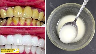 Blanquear Los Dientes En 2 Minutos Con Esta Mezcla Y Obtener Dientes Blancos Naturales [upl. by Greg]