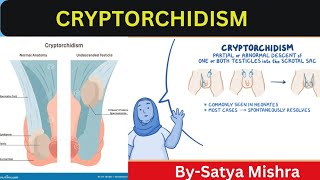 Cryptorchidism  Nursing Classes  Pediatric Nursing  Easy Explanation in Hindi [upl. by Ycrem649]