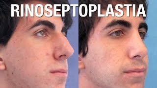 Rinoplastia Masculina  Antes y Después  Clínicas Diego de León [upl. by Scotney]