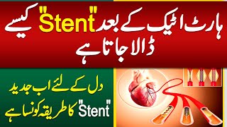 Heart Stent Procedure  Heart Stent Kaise Dalte Hain  Heart Attack Stent Procedure [upl. by Nivets]