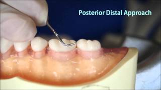 How to use Gracey Curette 1314그레이시큐렛 1314 사용 [upl. by Alboran]