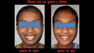 Braces Before and After  Part 5  Orthodontic treatment [upl. by Erasme]