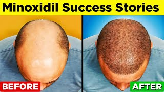 MINOXIDIL  A StepbyStep Guide to Regain Your Hair [upl. by Ileray958]