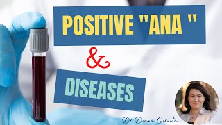 Positive ANA test antinuclear antibodies and autoimmune diseases [upl. by Benge]