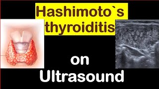 Hashimotos thyroiditis  AITon ultrasound [upl. by Petronia]