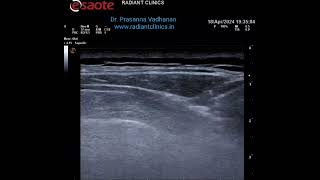 Dorsal scapular nerve block pain radiantclinics shorts [upl. by Milore]