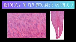 Histology of Dentinogenesis Imperfecta [upl. by Ayortal]