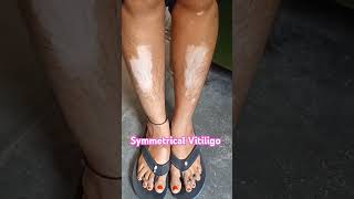 Vitiligo healthtipsinhindi dermatology skindiseases skin charmrog [upl. by Rotsen716]