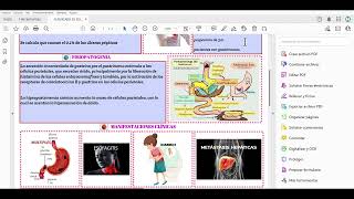 SINDROME ZOLLINGER ELLISON FLASHCARD GPC ENARM [upl. by Burney]