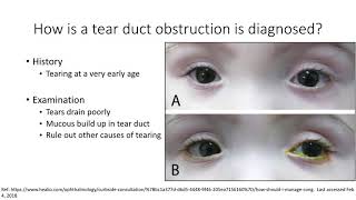 AAPOS Nasolacrimal Duct Obstruction [upl. by Acinomad]