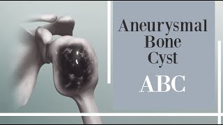 What is an Aneurysmal Bone Cyst Symptoms Causes Diagnosis and Treatment [upl. by Lankton]