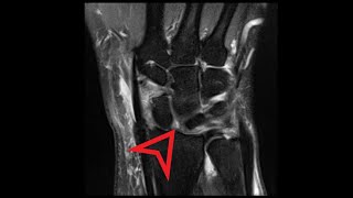 Wrist MRI Scapholunate Dissociation [upl. by Malloy]