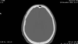 CASE 995 CT SKULL multiple lytic metastatic calvarial [upl. by Itnuahsa880]