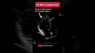 Heavy Trabeculations in Left Ventricular Apical Region  Echocardiography Made Easy [upl. by Eiramave]