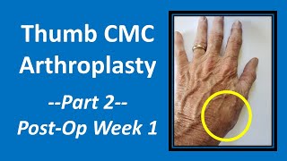 Thumb CMC Arthroplasty Part 2 PostOp Week 1 cmc [upl. by Odnuges520]