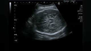 How to perform Middle cerebral artery MCA Doppler in fetus [upl. by Ripp]