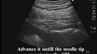 Ultrasoundguided pudendal nerve block [upl. by Gebelein]