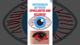 What are the Differences Between Episcleritis and Scleritis rheumatoidarthritisautoimmunediseases [upl. by Karee]