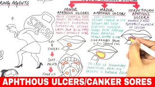 Aphthous Ulcers  Canker Sores  Pathophysiology Triggers Types amp Treatment [upl. by Iarahs]