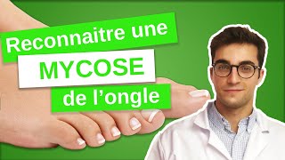 Savoir RECONNAÎTRE une MYCOSE de longle  Onychomycose 13 [upl. by Dorran141]