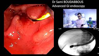 ERCP FOR BILIARY FISTULA AFTER LAPAROSCOPIC CHOLECYSTECTOMY [upl. by Vanya]