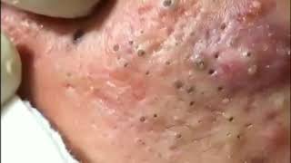 Best Blackhead Removal Ever 2020 [upl. by Callida247]