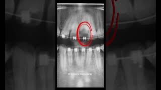 Por esto no debes usar brackets con caries [upl. by Prussian]