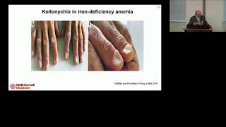 Polycythemia Vera and Myelofibrosis Patients Should Be Treated Early with Interferon  RT Silver MD [upl. by Savannah796]