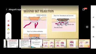 Mechanism of Graft Rejection  Allograft Rejection  Type IV Hypersensitivity [upl. by Haimarej]