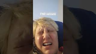 FND seizure aka non epileptic seizure functional neurological disorder [upl. by Livvi326]