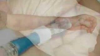 IV problem video from IVTEAM [upl. by Nawram299]