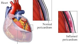 Pericarditis [upl. by Gemmell]