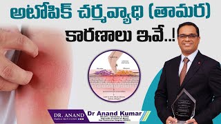 అటోపిక్ చర్మవ్యాధి తామర కారణాలు  Causes of Atopic Dermatitis in Telugu  Dr Anand Hair And Skin [upl. by Assyral866]