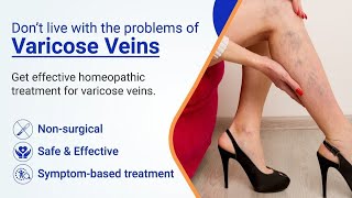 Vericose Veins Treatment  Scelero Therapy vericose veins yt treanding viralvideo [upl. by Grazia]