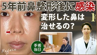 【30代女性の美容整形】鼻整形後に感染で鼻が変形してしまった方がご来院されました！手術当日の様子①【リッツ美容外科】 [upl. by Jameson]