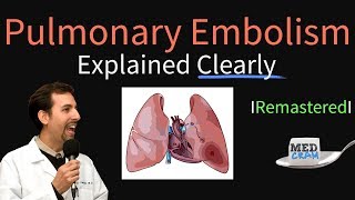 Pulmonary Embolism Remastered  Pathophysiology Symptoms Diagnosis DVT [upl. by Portwin975]