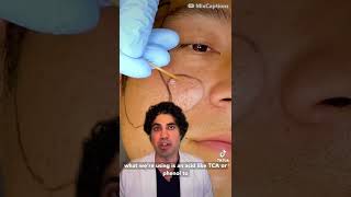 Ice Pick Scar Treatment by Dr Nadir Qazi [upl. by Adallard]