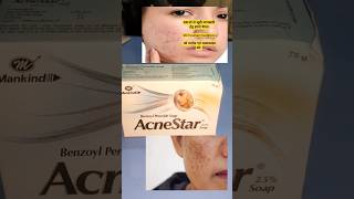 कील मुहांसे से पाएं छुटकारा  AcneStar soap  skincare skincare beuty shorts ytshorts [upl. by Aleka]