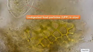 Undigested food particles in faeces Microscopy at 400X and 800X [upl. by Rebmaed]