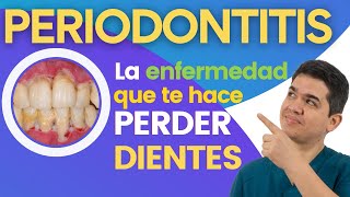 😱 PERIODONTITIS Todo lo que debes saber para no perder tus dientes [upl. by Nodgnal]