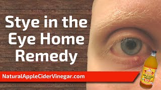 The Best Home Remedy for Stye In The Eye [upl. by Eloise]