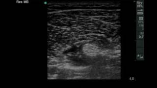 Ultrasound guided Infragluteal Sciatic Nerve Blockmov [upl. by Fang]