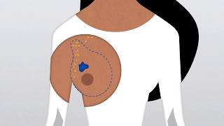 How Do Doctors Diagnose and Treat Breast Cancer [upl. by Dnamra286]