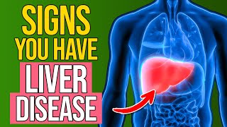 15 Warning Signs You May Have Liver Disease [upl. by Shea]