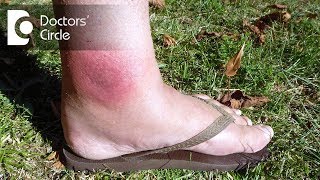 How to manage spider bite with swelling amp redness  Dr Nischal K [upl. by Anala]