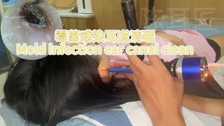 Mold infection ear canal clean [upl. by Hall]